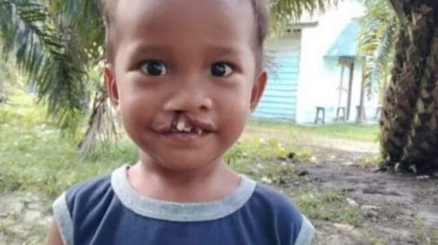 Operasi bibir sumbing