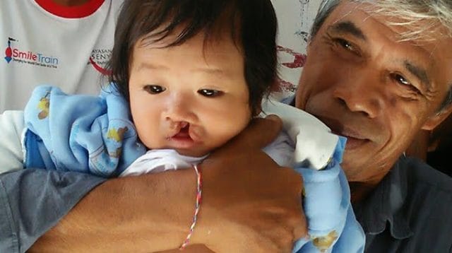 Ilustrasi bibir sumbing